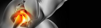 Causantes de la Bursitis de Cadera en atletas y como tratarlo en FisioClinics Madrid 