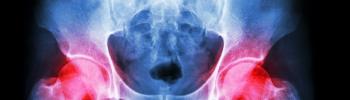 En qué consiste la Osteonecrosis de Cadera y cuales son sus principales signos clínicos