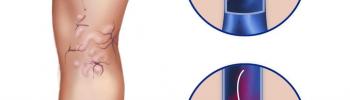 Drenaje Linfático Manual y Masaje Circulatorio para tratar las Várices Drenaje Linfático Manual y Masaje Circulatorio para tratar las Várices