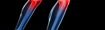 Factores desencadenantes del dolor de rodilla o Gonalgia y su tratamiento en FisioClinics Madrid Factores desencadenantes del dolor de rodilla o Gonalgia y su tratamiento en FisioClinics Madrid