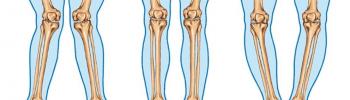 Alteraciones en la rodillas: Genus Varus y Genus Valgus y sus diferentes características