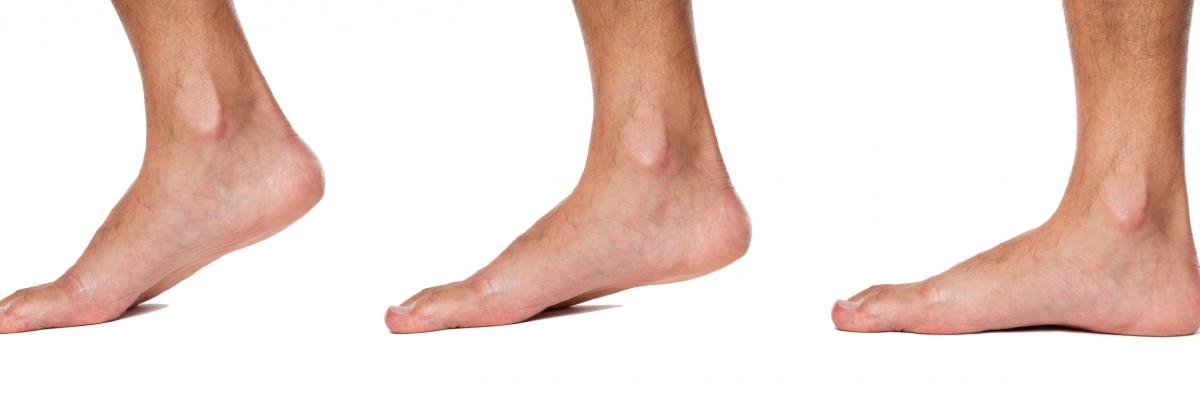 Diferentes tipos de deformidades de pie y su tratamiento fisioterapéutico