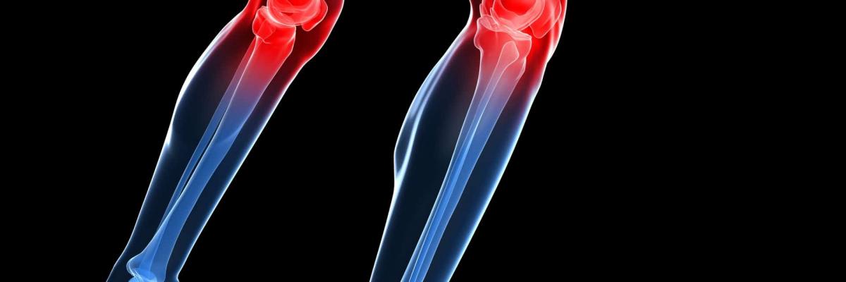 Factores desencadenantes del dolor de rodilla o Gonalgia y su tratamiento en FisioClinics Madrid