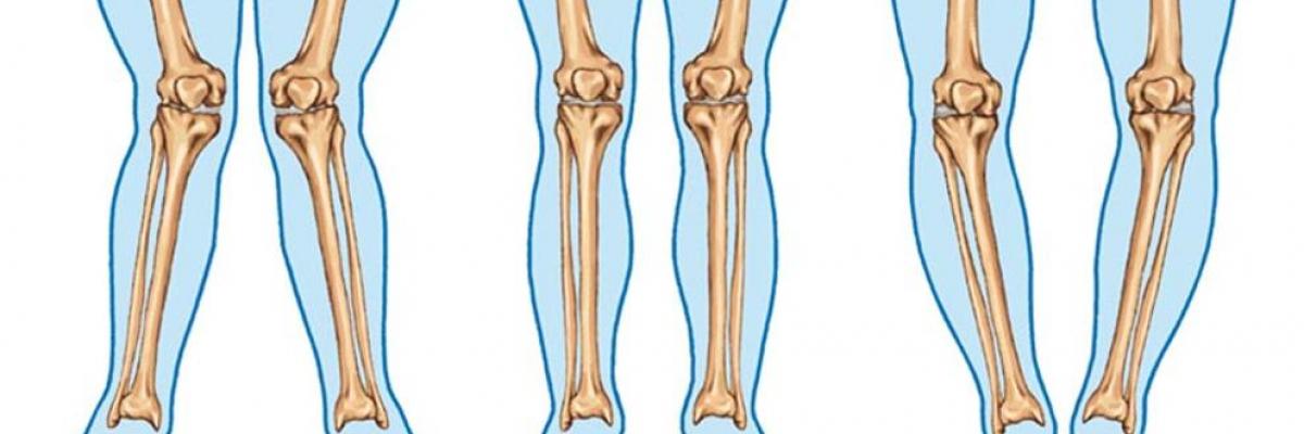 Alteraciones en la rodillas: Genus Varus y Genus Valgus y sus diferentes características