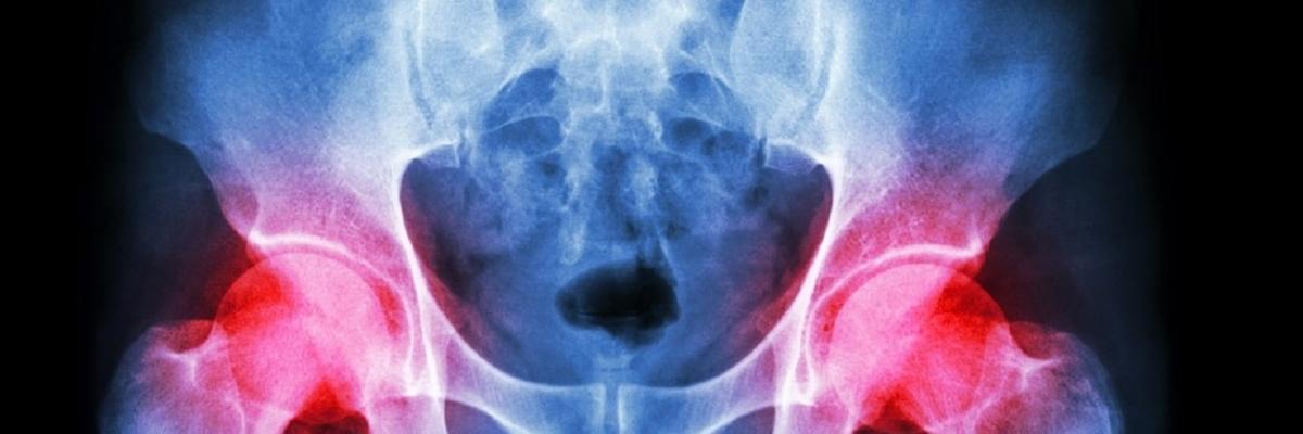 En qué consiste la Osteonecrosis de Cadera y cuales son sus principales signos clínicos