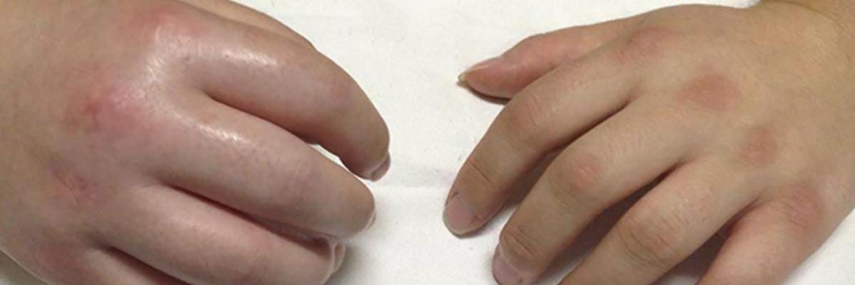 Aplicación de drenaje linfático en la distrofia simpático refleja o Sudeck